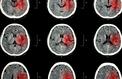Six choses à savoir sur les accidents vasculaires cérébraux