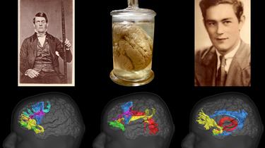 Ces trois accidents qui ont révolutionné les neurosciences