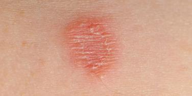 Teigne - Quels symptômes ? - Fiches santé et conseils médicaux