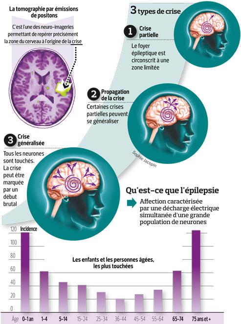 Épilepsie : Les Résultats Intéressants De La Chirurgie