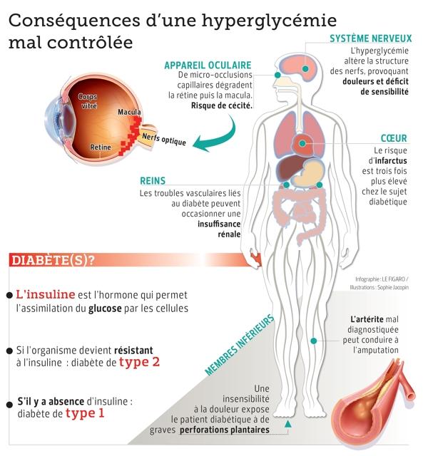 Complications Du Diabète - Diabète Guyane Obésité