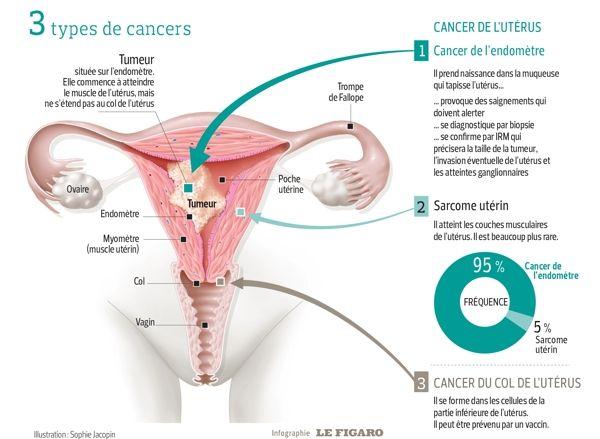 Cette infographie prÃ©sente les cancers de la zone utÃ©rine selon leur emplacement