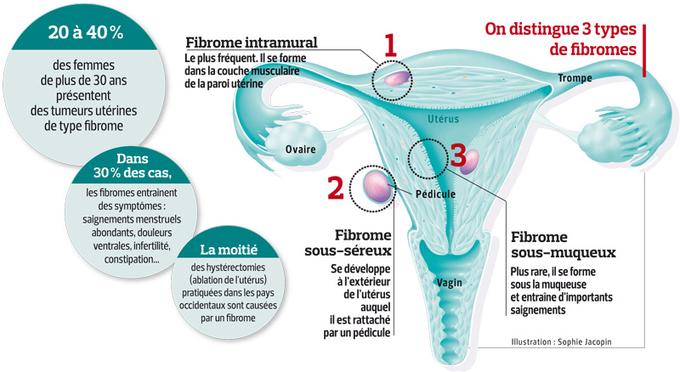 Fibromes Utérins - Qu'est-ce Que C'est ? - Fiches Santé Et Conseils ...