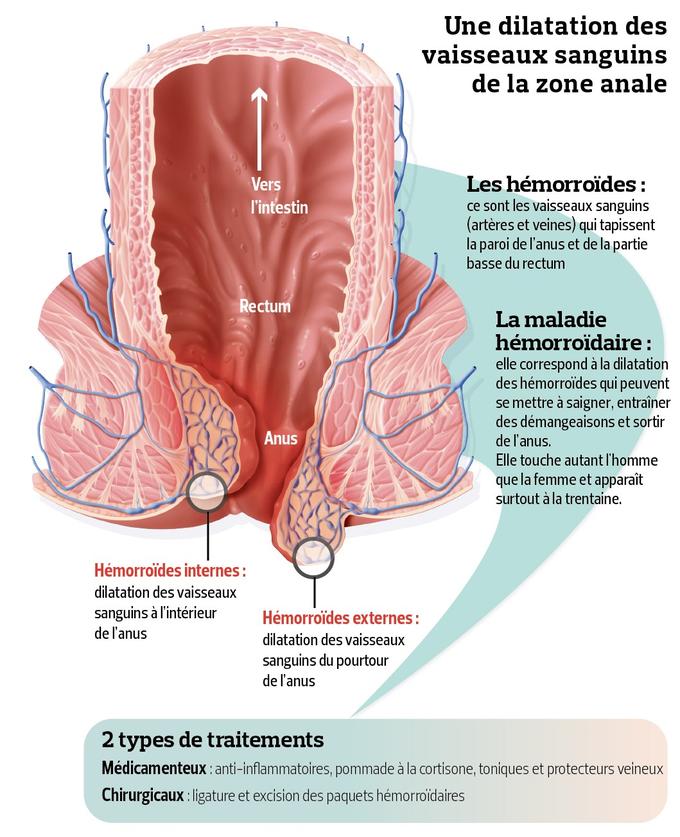 traitement pour hémorroïdes externes traitement pour hémorroïdes externes