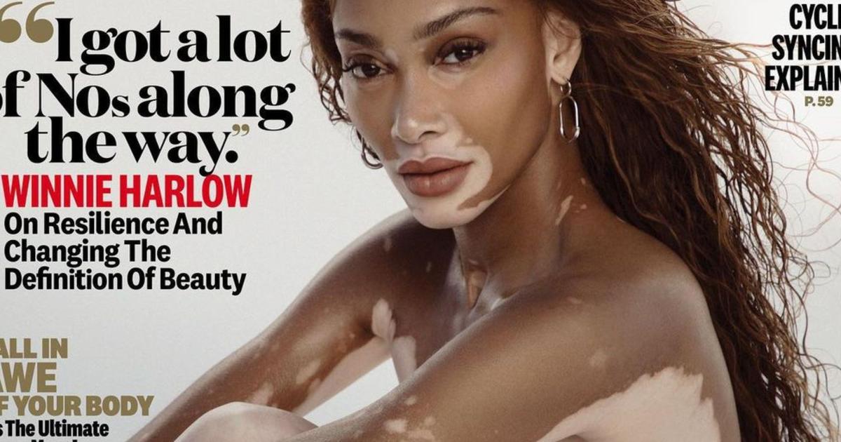 winnie-harlow-mannequin-atteint-de-vitiligo-pose-nue-pour-le-magazine