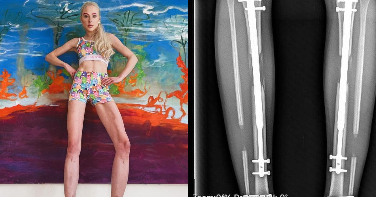 The model spent 146,000 euros to lengthen her legs and revealed the final result on Instagram.