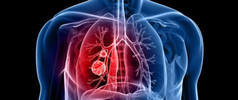 Cancer du poumon : informations et actualités