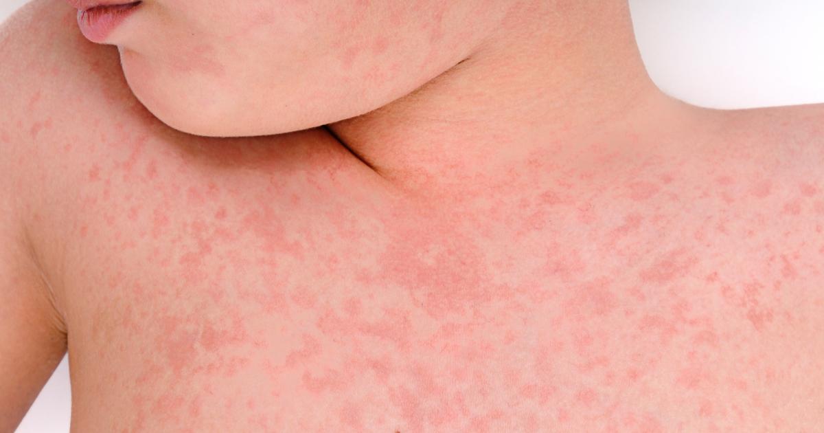 Beginning of an “endemic” measles epidemic in the Rhône department