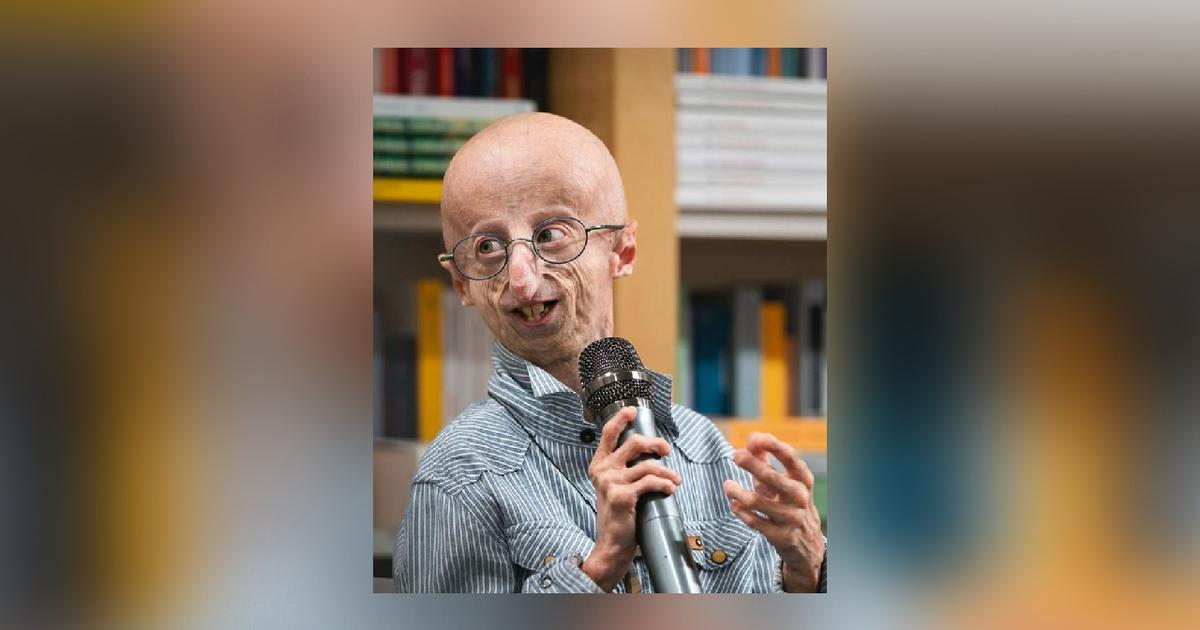 Een patiënt die leed aan progeria, de oudste ter wereld, stierf op 28-jarige leeftijd