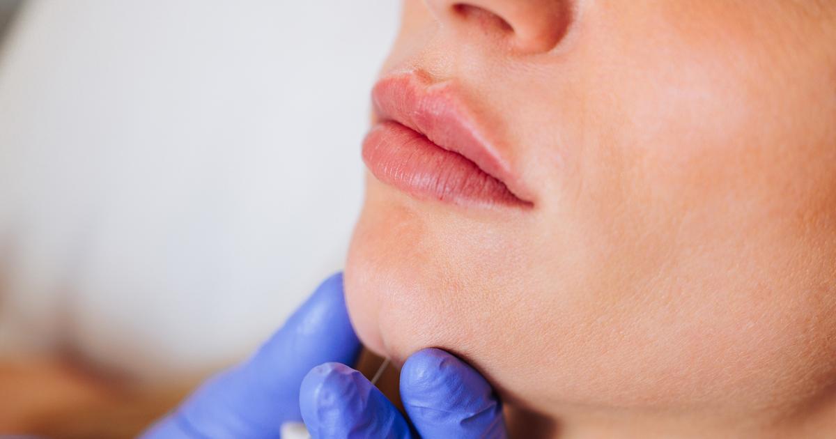 « Il m’a opérée comme ça, sans assistant, dans son bureau des beaux quartiers » : Louise, 45 ans, revient sur sa chirurgie ratée du menton