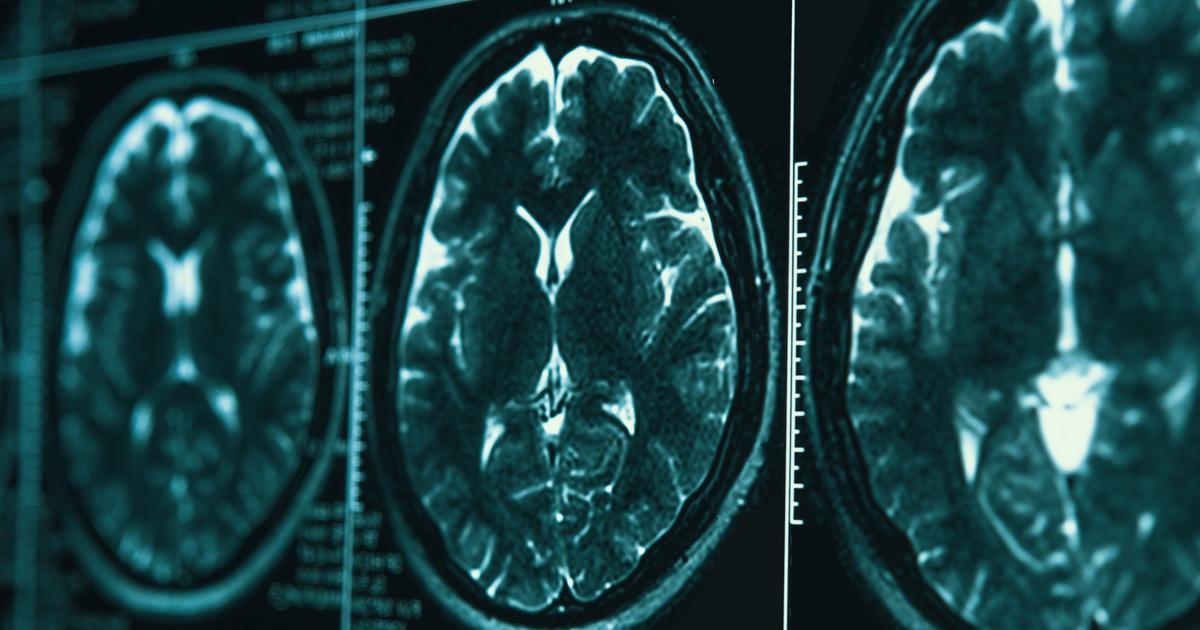 «Une première étape de franchie» : pour soigner la maladie de Parkinson, une piste se précise