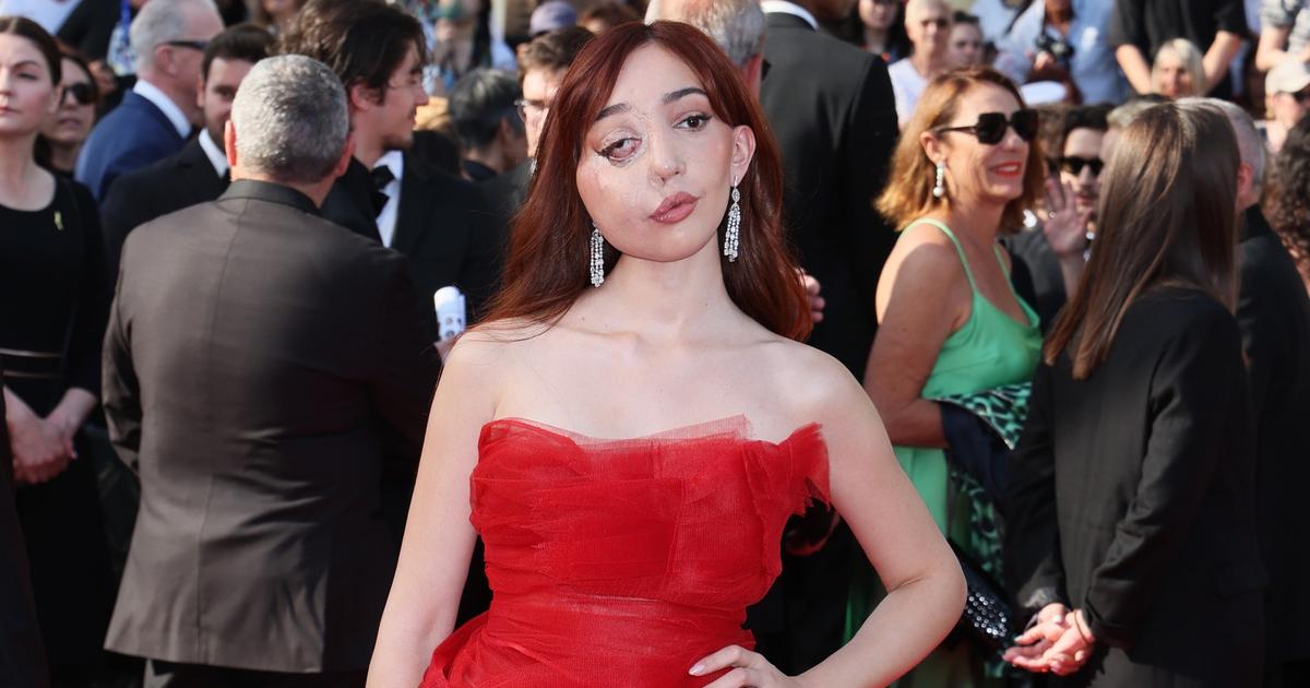 Qui est Nikki Lilly, cette militante atteinte d’une malformation au visage qui a ému le tapis rouge de Cannes ?