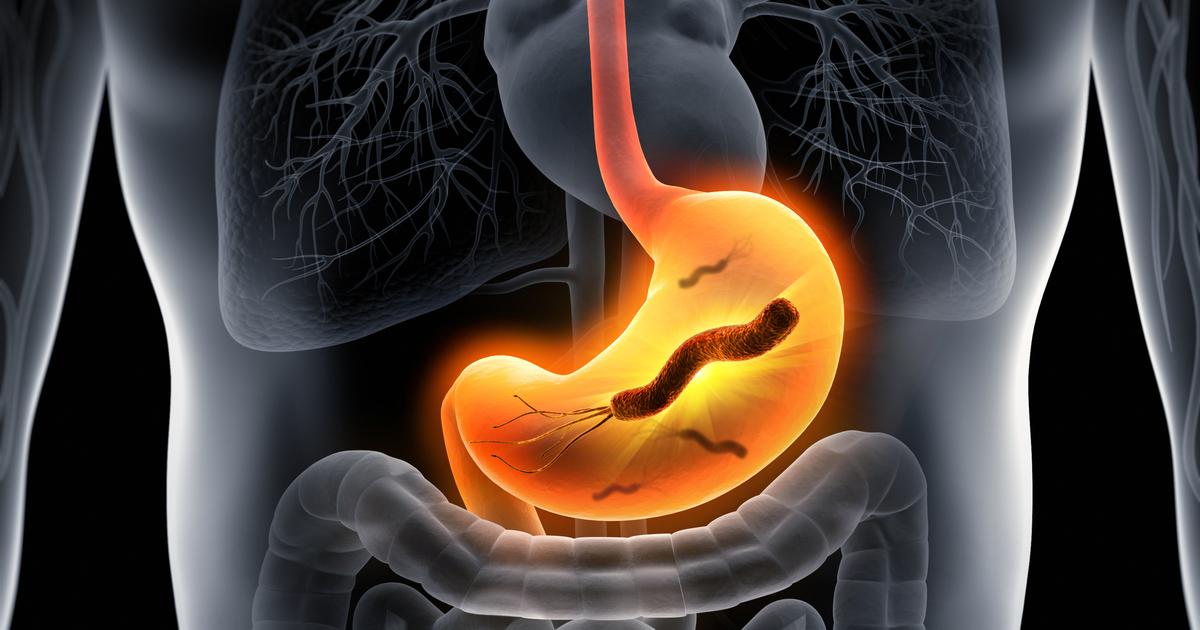 Helicobacter pylori and Stomach Cancer Risk