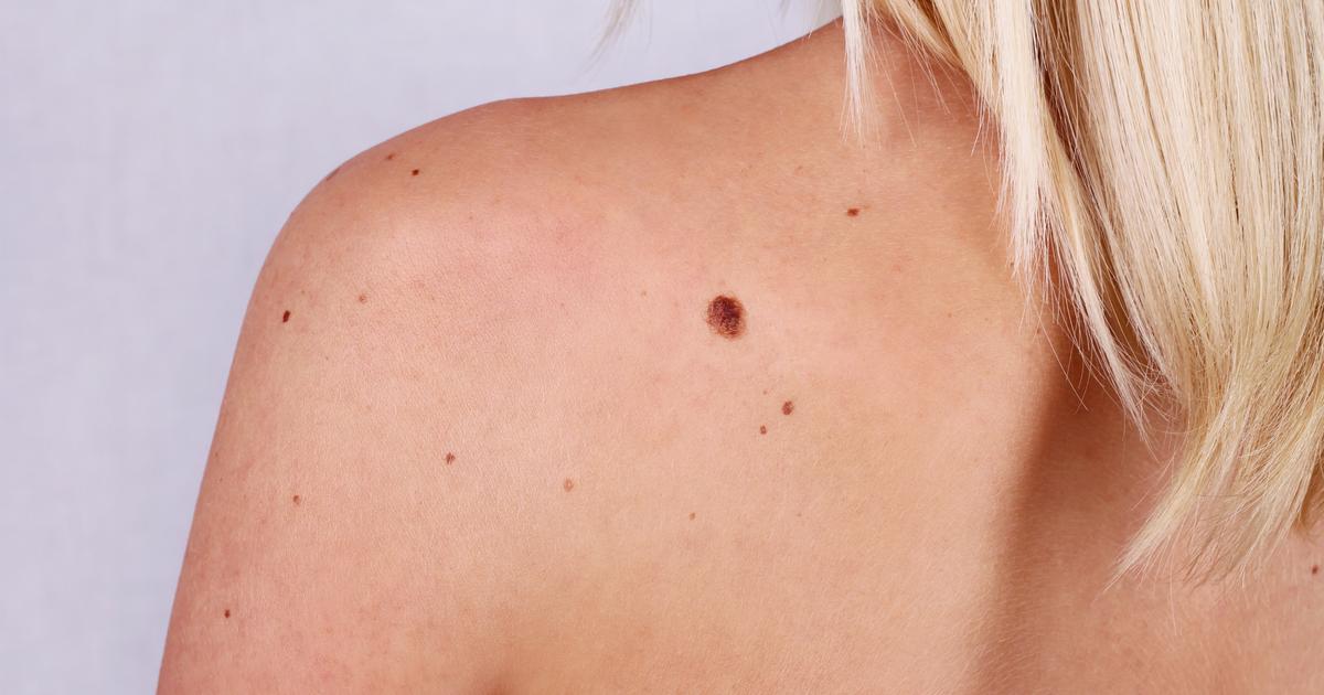 Dermatologists: AI Screening “Drifts” – Risks & Solutions