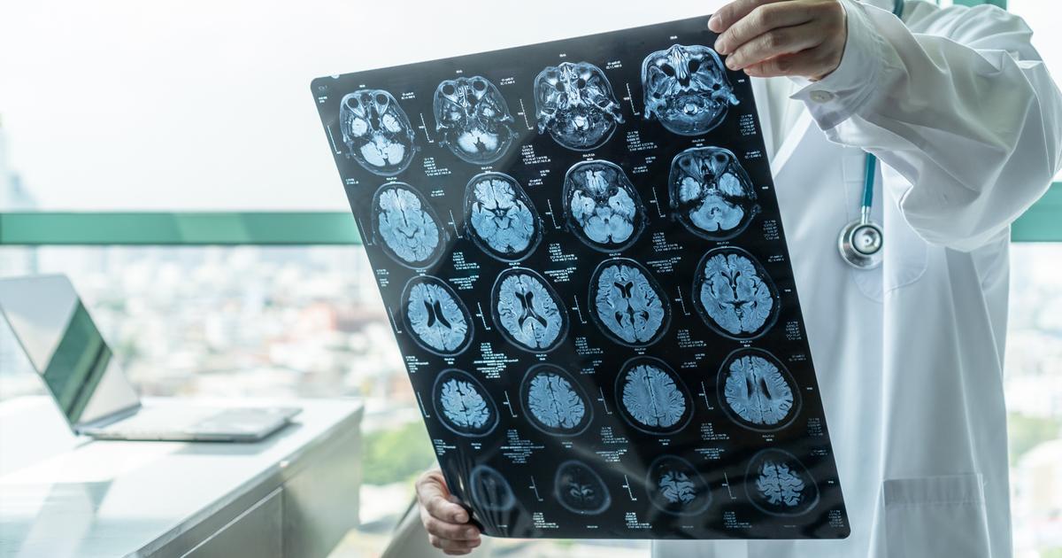 Pr Frédéric Blanc : «On peut faire reculer les maladies neurodégénératives»