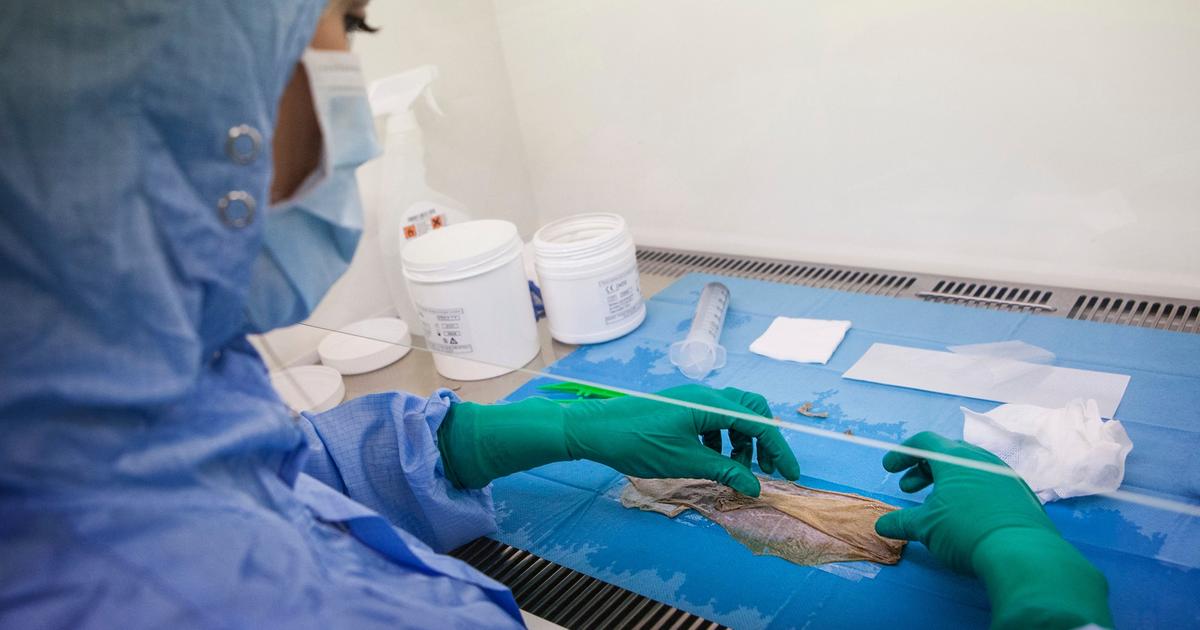 Grands brûlés: s’inspirer de la relation mère-fœtus pour éviter le rejet de greffe de peau