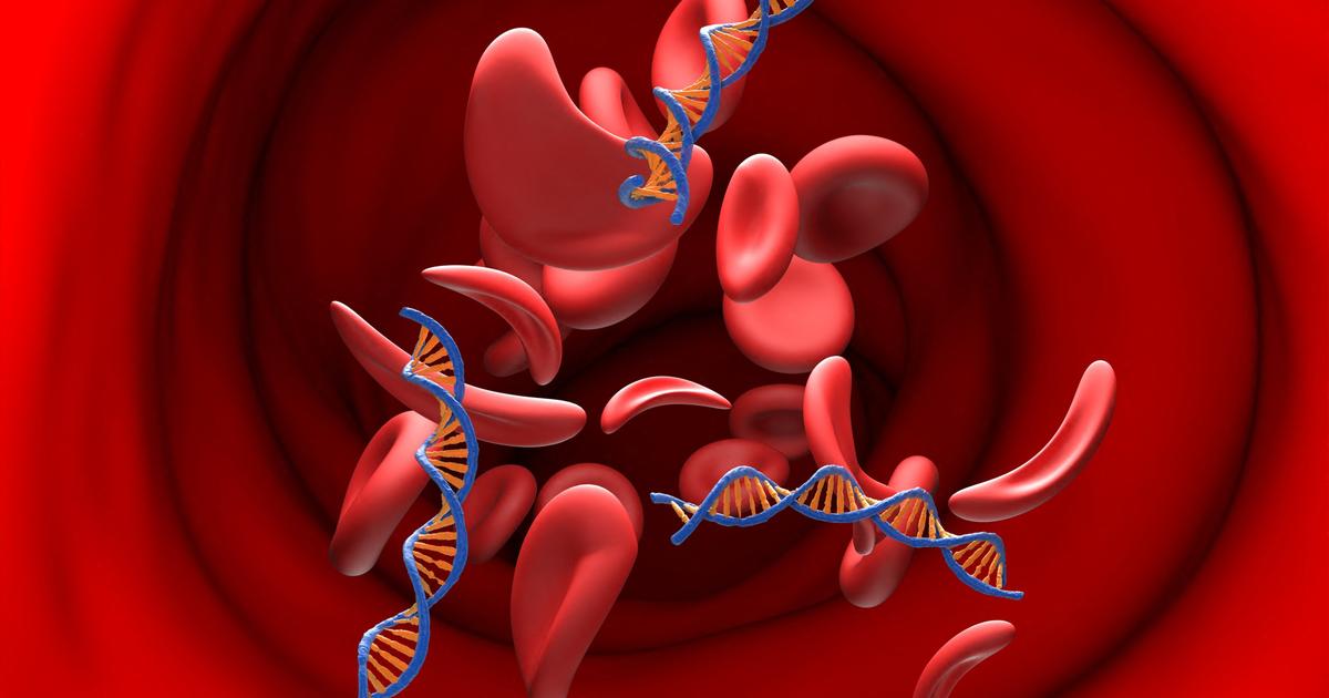 Au Sénégal, un médicament générique africain fait naître un nouvel espoir contre la drépanocytose