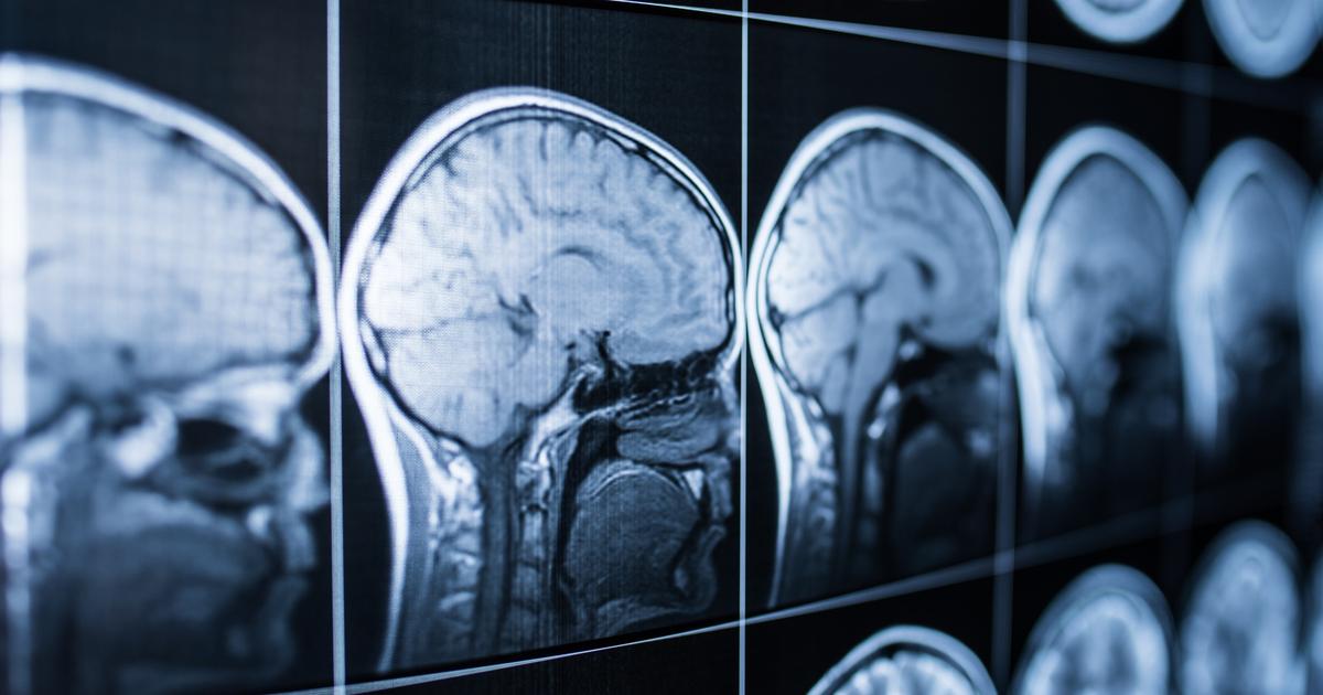 Des trous microscopiques dans le crâne laissent les cellules immunitaires entrer directement dans le cerveau