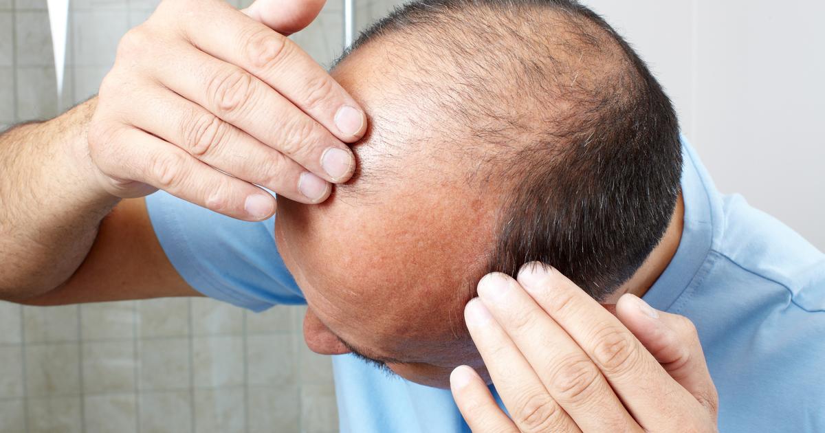 Quelles solutions thérapeutiques pour traiter la calvitie, après le tour de vis sur le finastéride ?