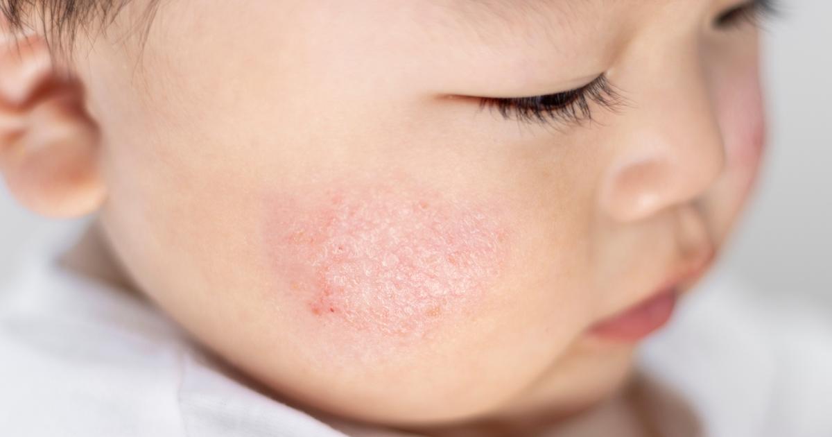Stress et eczéma : un circuit nerveux identifié comme déclencheur des poussées