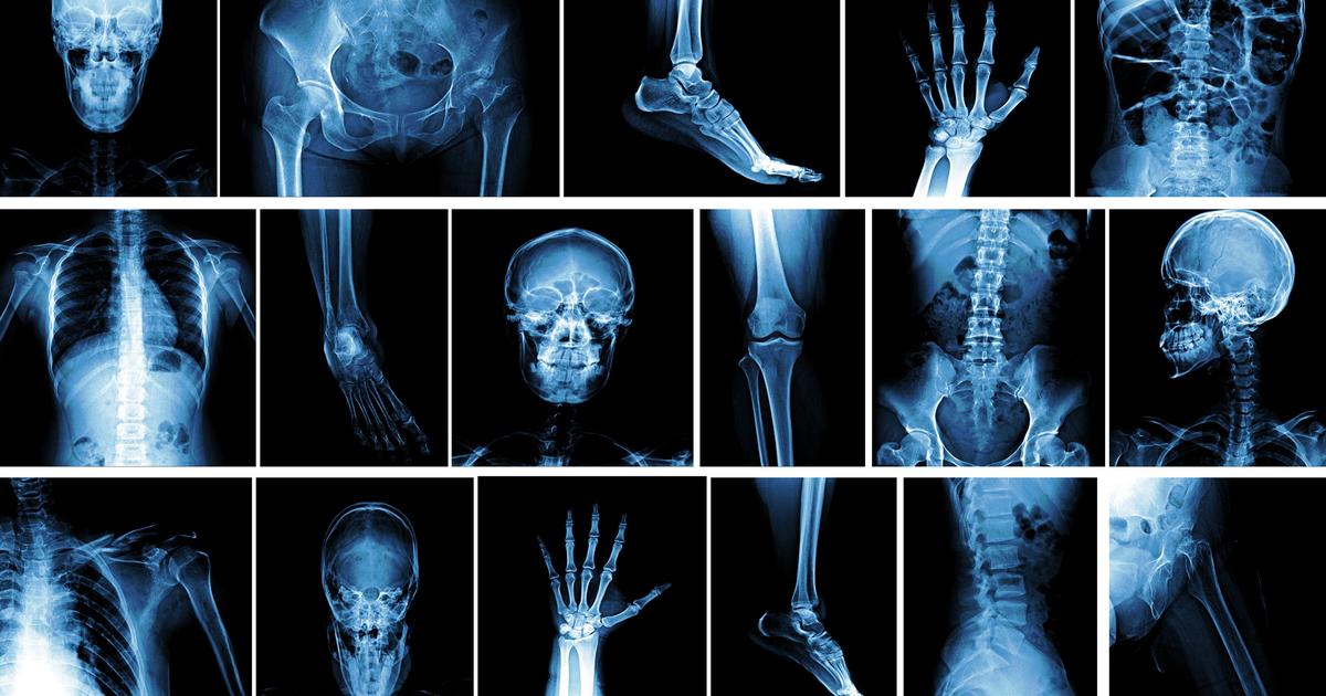 Les polluants éternels pourraient nuire à la croissance osseuse