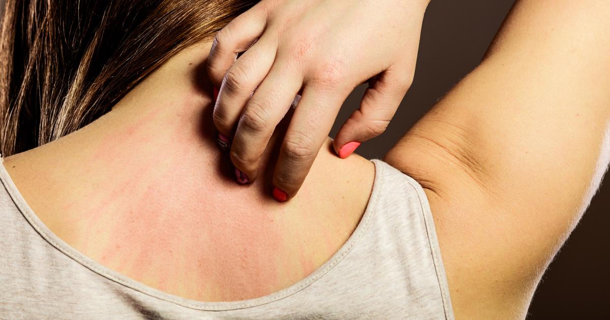 Des poux, des puces ou des «morgellons» : le syndrome d’Ekbom, ou la conviction délirante d’avoir des parasites dans la peau