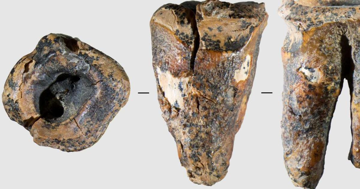 Il y a 60.000 ans, Néandertal soignait-il déjà les caries dentaires ?