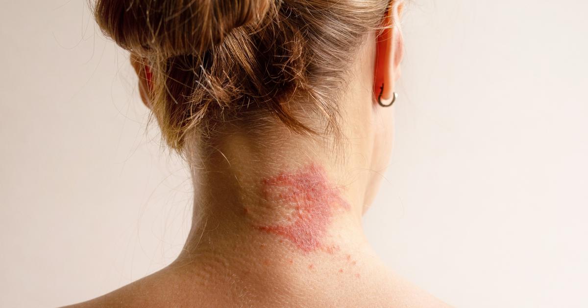 Scolarité, carrière, estime de soi : les cicatrices invisibles de l’eczéma