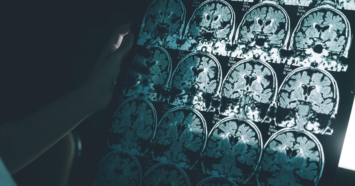 Atteinte d’Alzheimer, elle retrouve fugacement ses souvenirs grâce à des champignons hallucinogènes