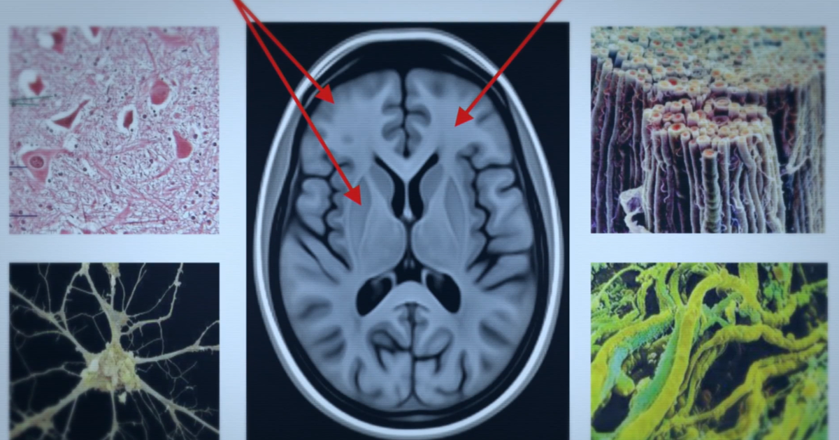 « Un cerveau particulier » : loin des clichés sur les personnes HPI