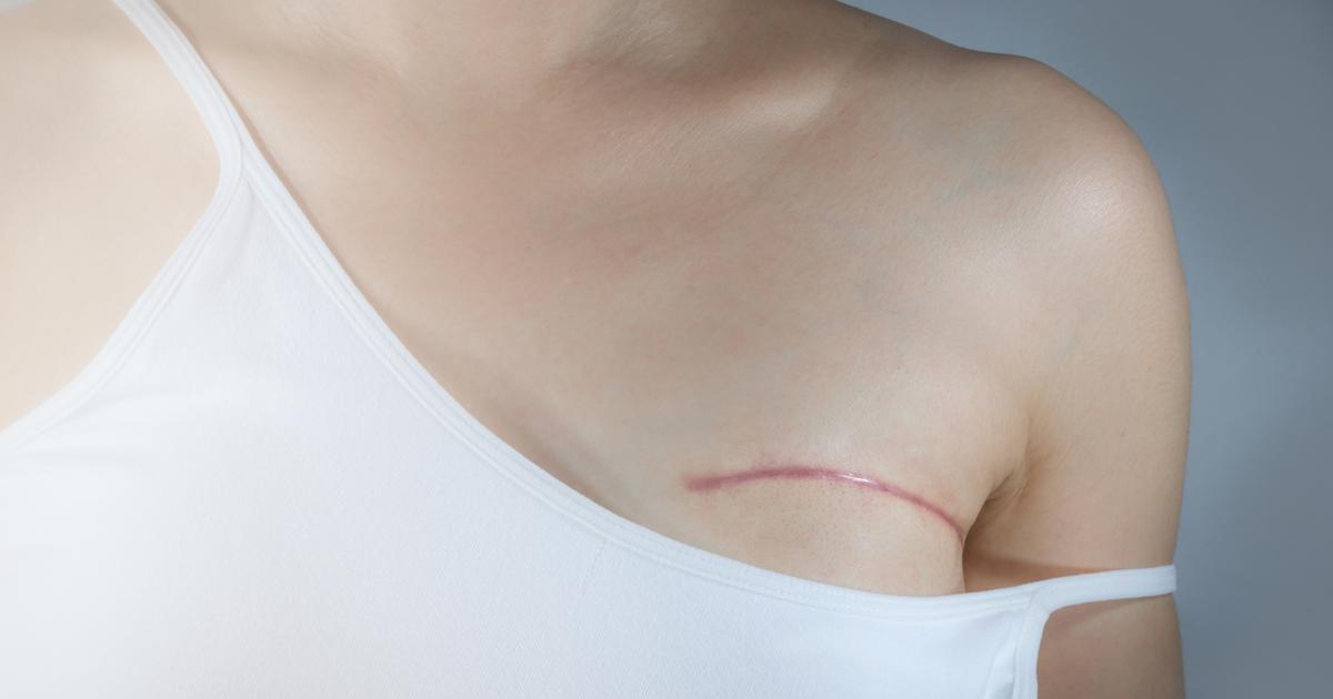 Cancer du sein : implants, greffes de graisse, bioprothèses… comment se reconstruire après une opération ?