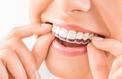 Gouttières dentaires : dans quels cas les utiliser ?