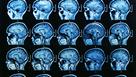 Covid-19 : le virus est capable de pénétrer dans le cerveau et d'y infecter les neurones