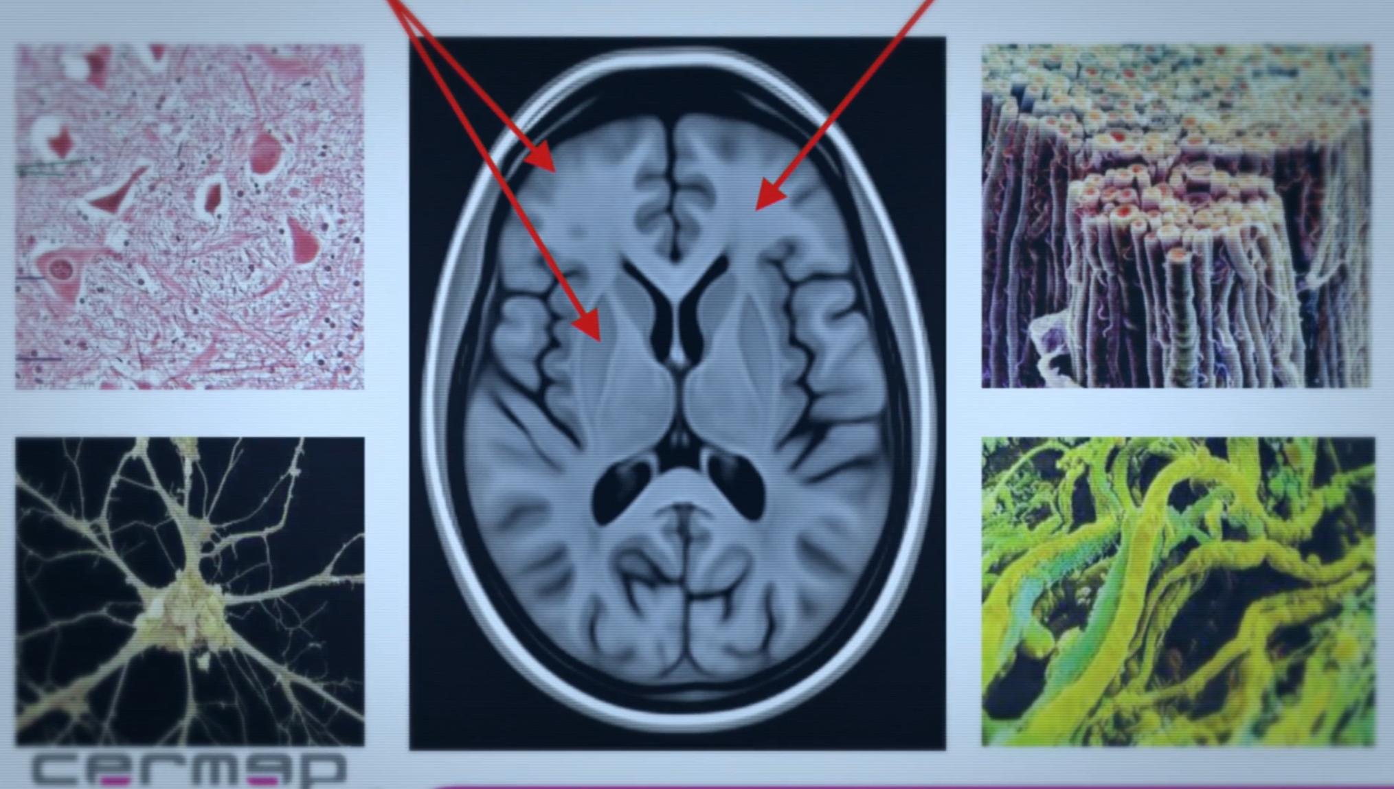 « Un cerveau particulier » : loin des clichés sur les personnes HPI