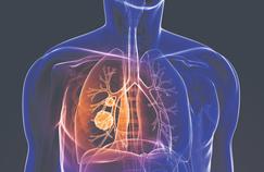 Une thérapie ciblée prolonge la vie dans certains cancers du poumon