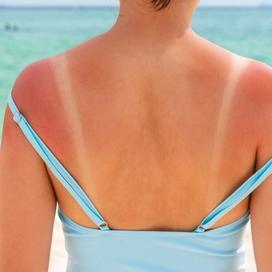Une peau rougie par le soleil prendra-t-elle une teinte dorée aprÚs coup?