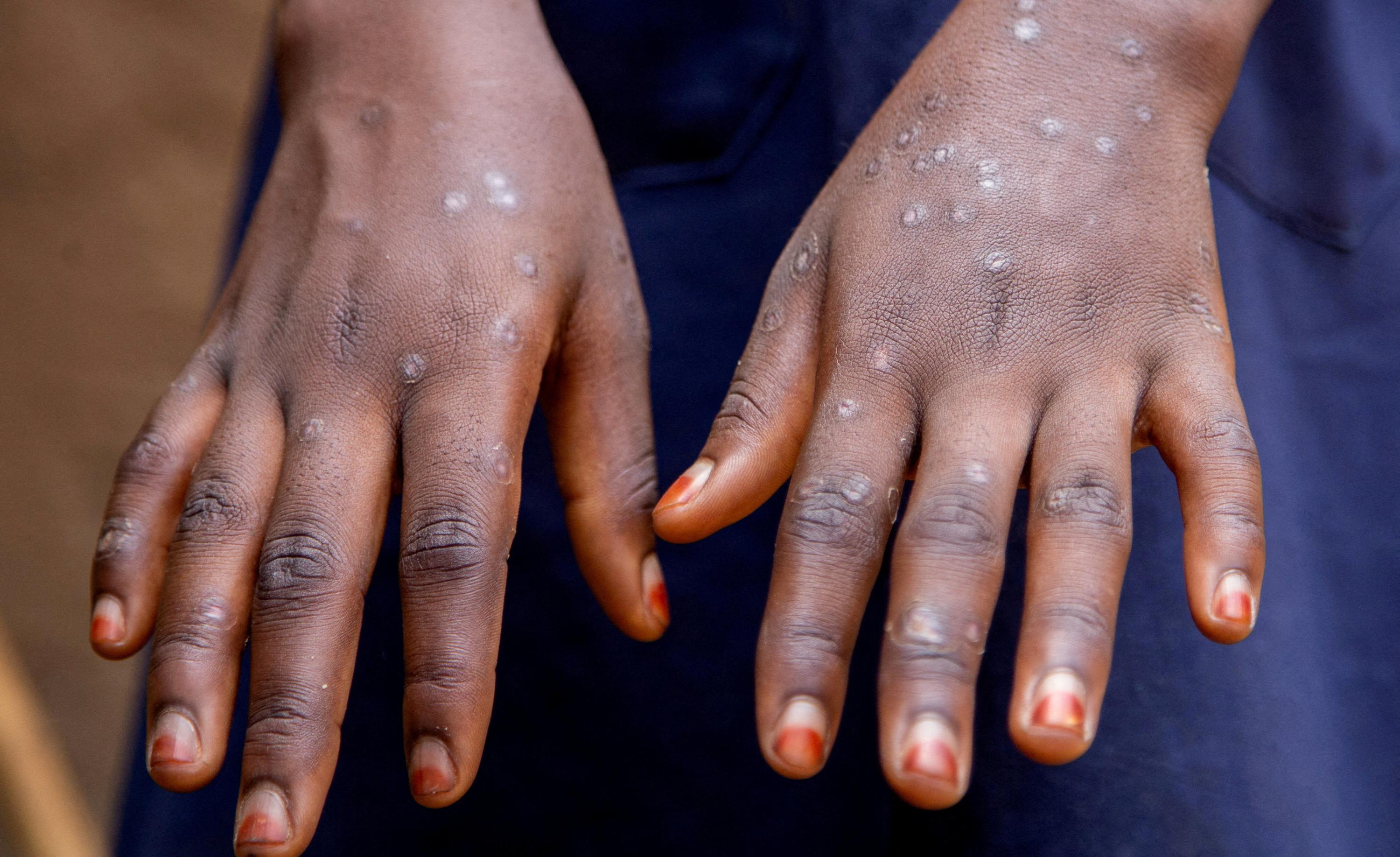 Mpox : 866 décès en Afrique depuis le début de l'année, selon l'Africa CDC