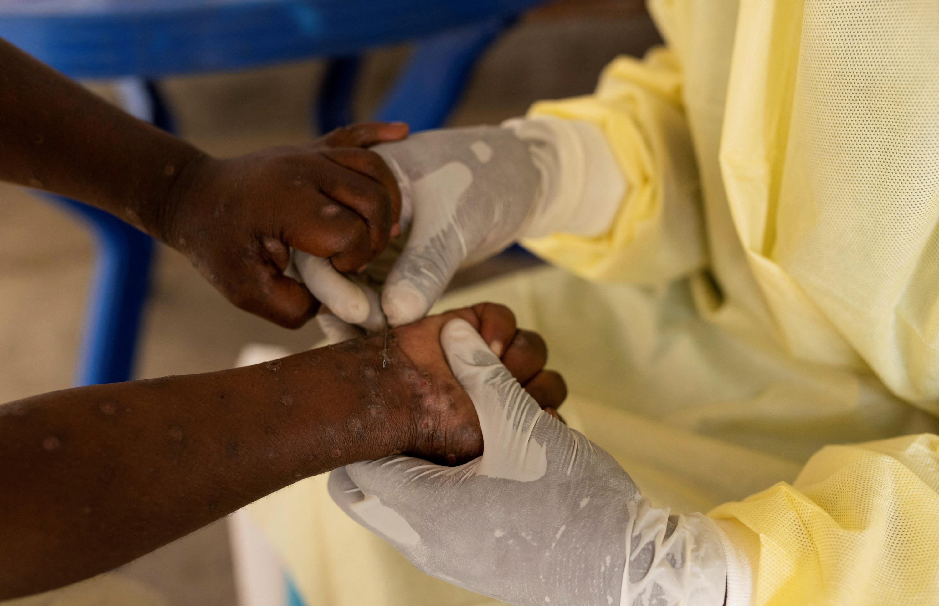 Mpox : le plus haut niveau d'alerte sanitaire mondiale déclenché par l’OMS