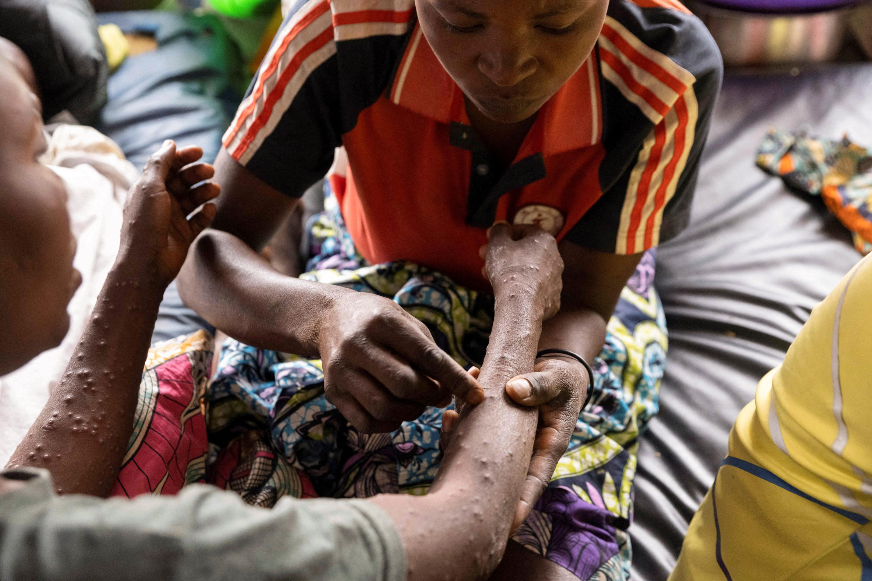 Mpox : les premiers vaccins sont arrivés en RDC, épicentre de l'épidémie