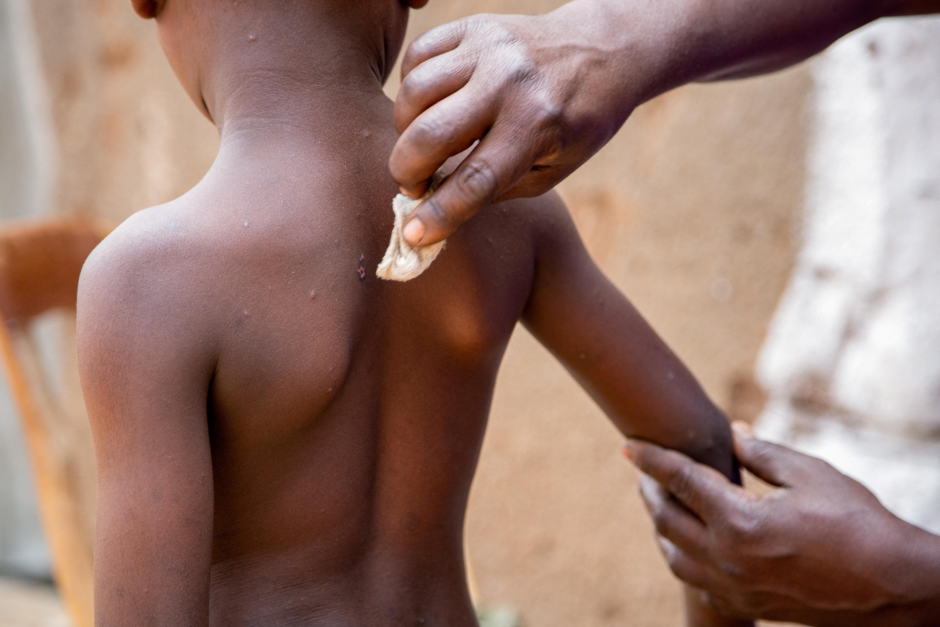 Virus mpox : l’OMS donne son accord pour commercialiser un test de diagnostic