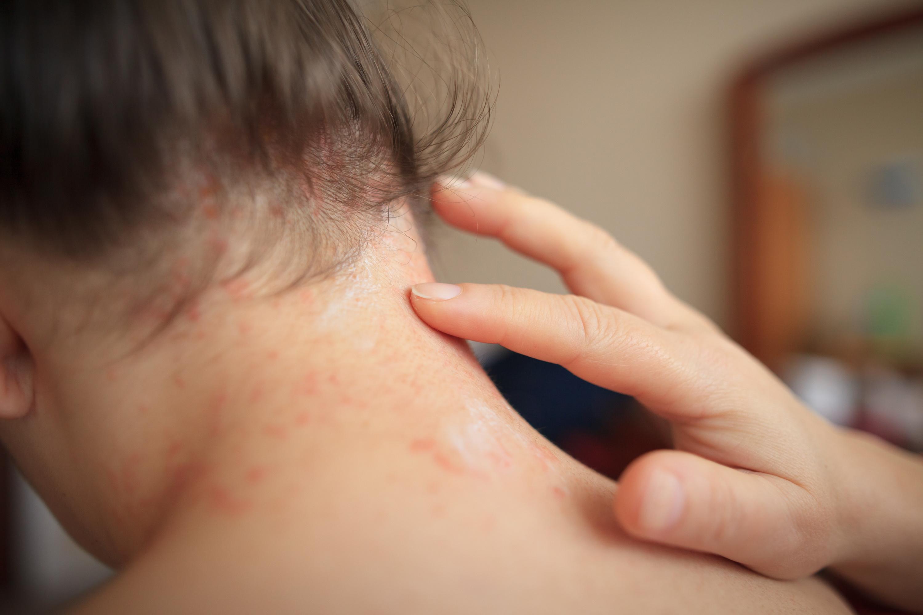 Dans le Sud-Ouest, une pénurie de dermatologues expose certains patients à des «pertes de chance» de guérison