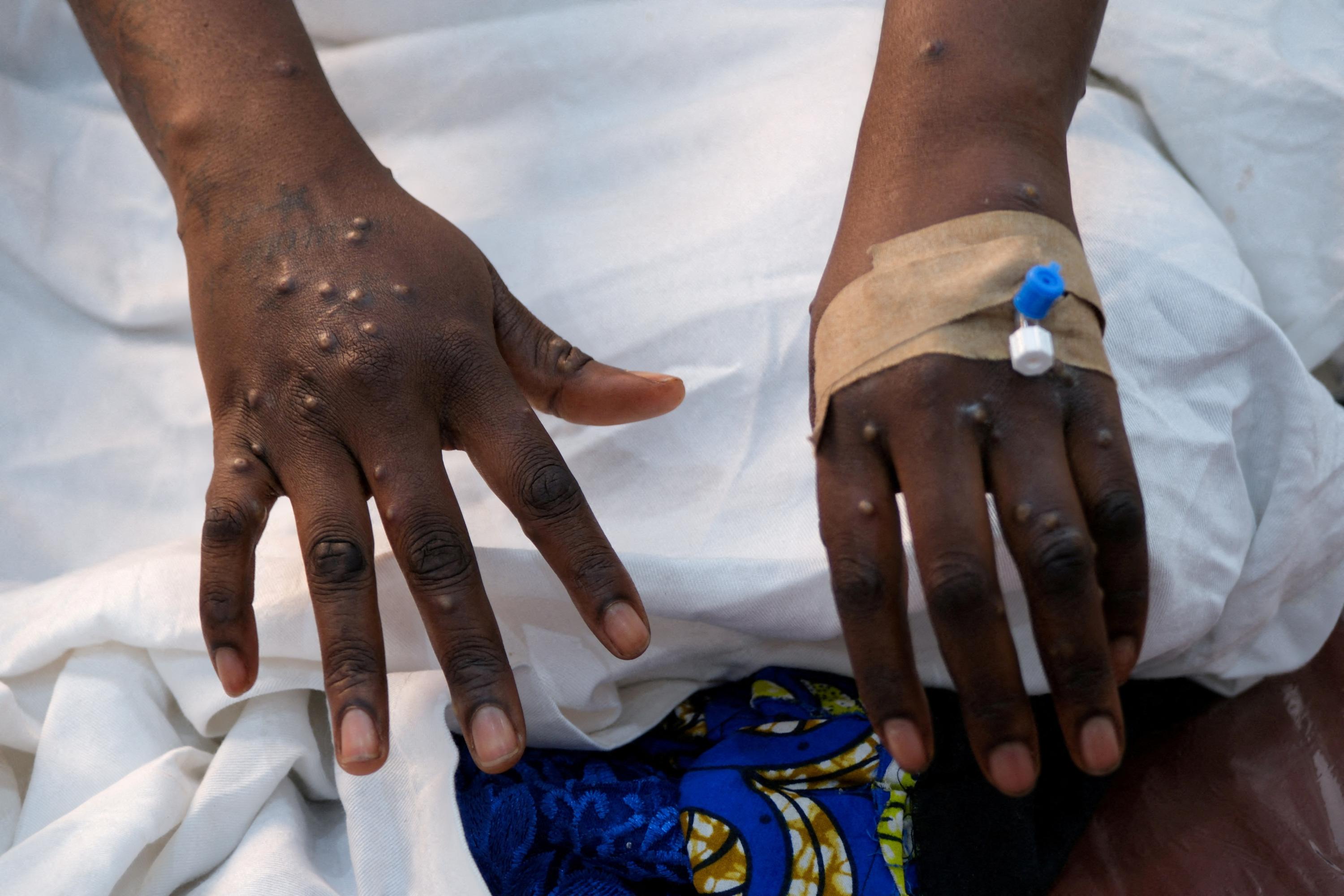 Mpox: le nouveau variant se transmet surtout entre humains