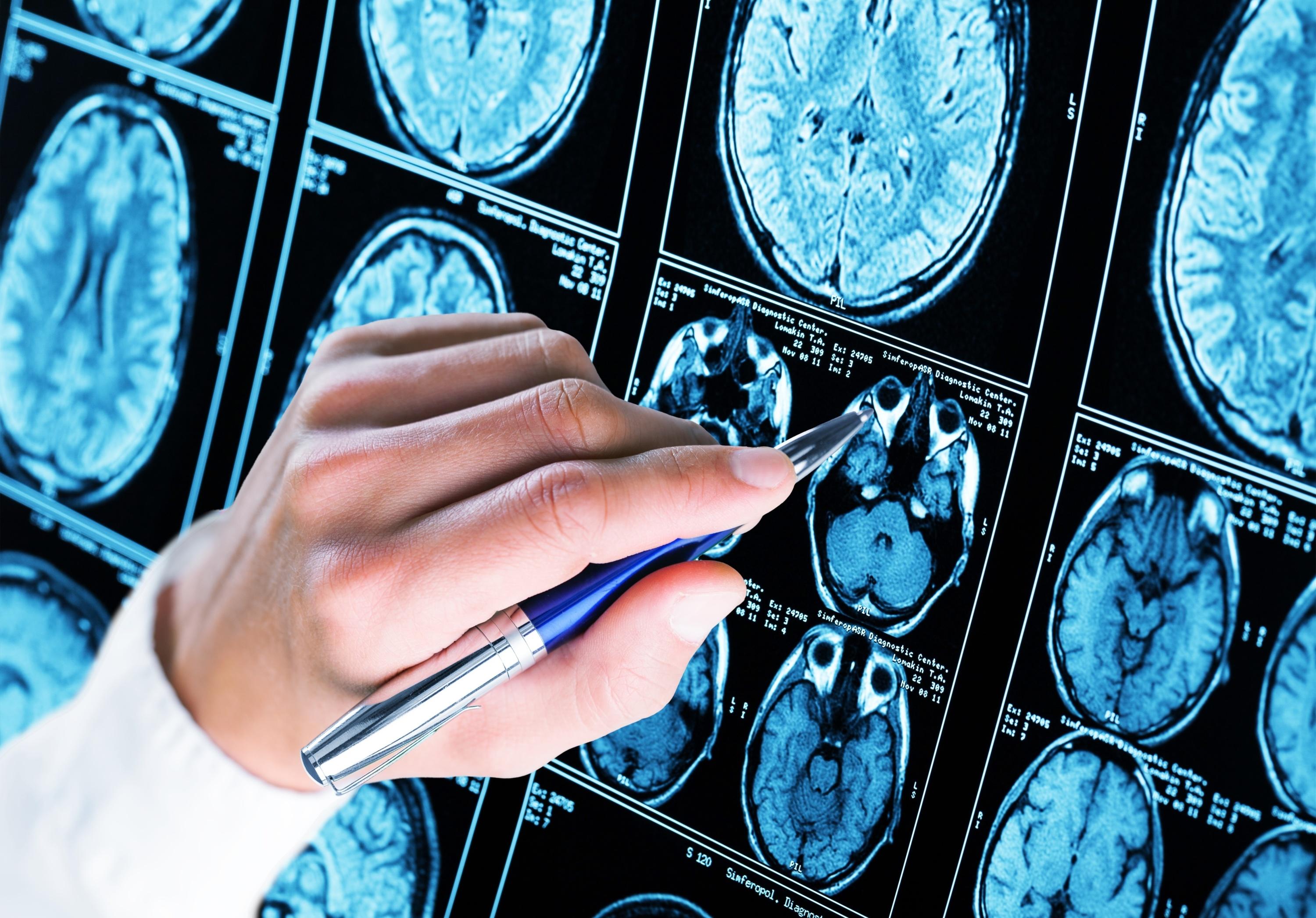 Les États-Unis approuvent le premier test sanguin de dépistage d'Alzheimer