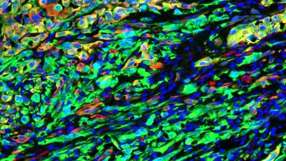Photographie d'un mécanisme de résistance des cellules cancéreuses appelé « transition épithélio-mésenchymateuse », au microscope électronique. Au fil des chimiothérapies, les cellules cancéreuses passent d'un état épithélial, très structuré (en rouge) à un état mésenchymateux, où elles deviennent invasives (en vert) et donc résistantes au traitement.