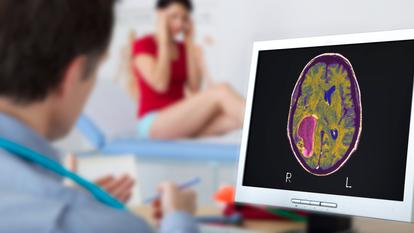 Glioblastoma represents 20% of all brain tumors. It is feared because of its rapid and simultaneous development in several areas of the brain.