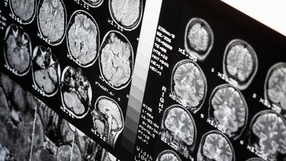 Les formes génétiques de la maladie de Charcot concernent 10% des patients