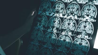La maladie d’Alzheimer sur une image IRM.