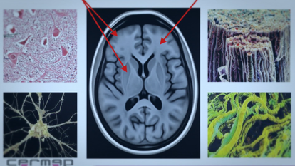 Image issue du documentaire Un cerveau particulier diffusé sur Public Sénat