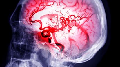Les accidents vasculaires cérébraux (AVC) sont liés à l’interruption brutale d’oxygénation du cerveau.
