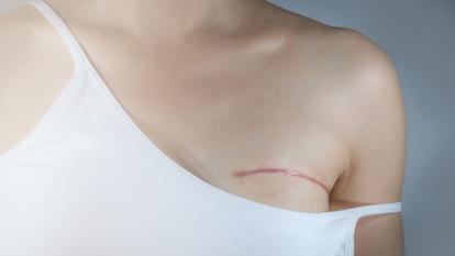 Après une mastectomie, seules 34 % des femmes opérées en 2021 avaient bénéficié d’une reconstruction mammaire dans les trois ans, malgré les progrès des techniques chirurgicales, selon l’INCa.